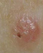Skin Cancer - a Reminder